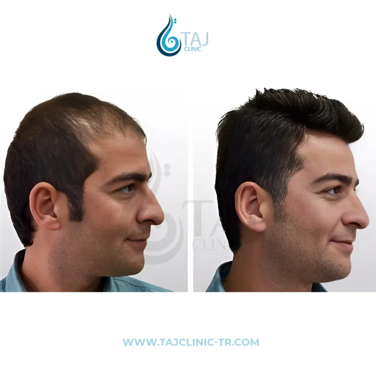 Comparație înainte și după transplantul de păr din galeria Taj Clinic, caz 3