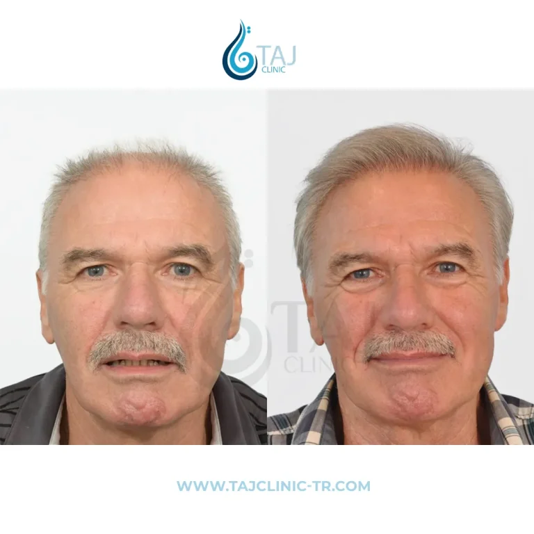 Comparație înainte și după transplantul de păr din galeria Taj Clinic, caz 2