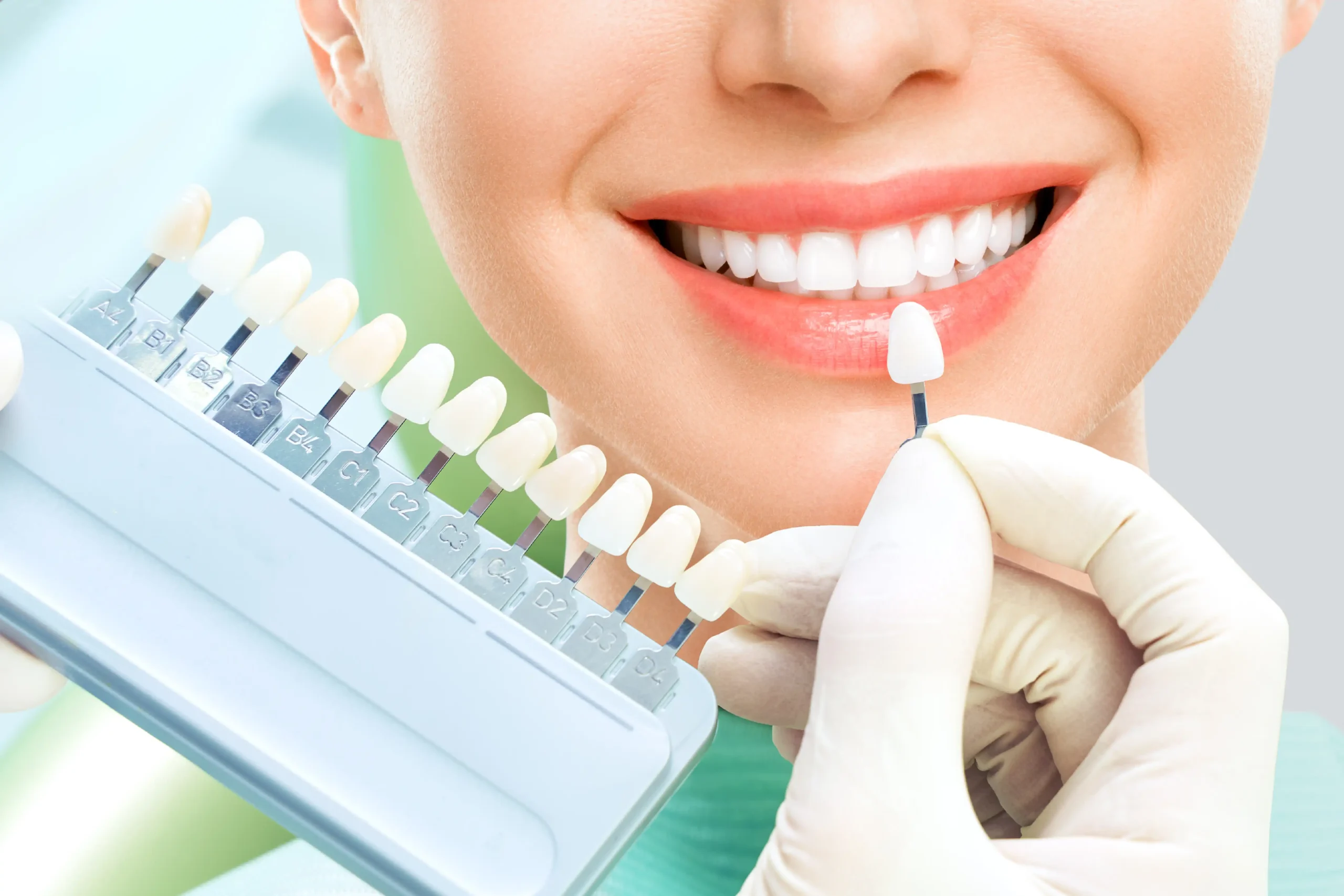 Blanchiment des dents ou facettes ? Comment discuter du bon choix pour votre sourire