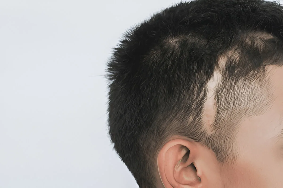 Greffe de cheveux sur plaies et brûlures